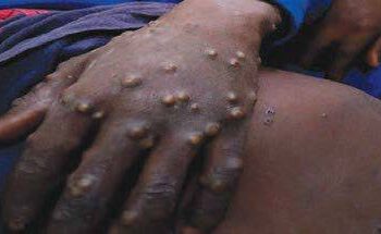 Monkeypox In Nigeria By Ikelegbe Vivian Uzezi