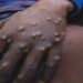 Monkeypox In Nigeria By Ikelegbe Vivian Uzezi